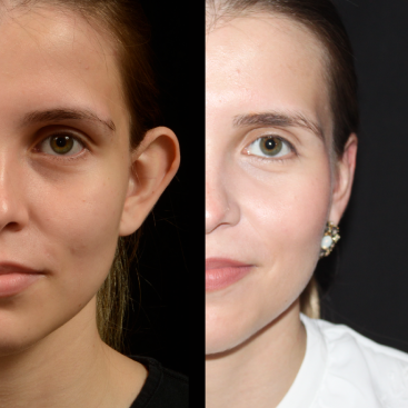 Otoplastia para un armonioso equilibrio facial